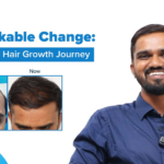Unlock Your Confidence with VCare's Revolutionary Hair Regrowth Solution! Unlock Your Confidence with VCare's Revolutionary Hair Regrowth Solution!
