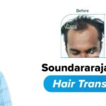 REVERSING BALDNESS WITH VCARE 