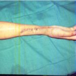 Real-life story: Reconstruction of hand and dramatic recovery